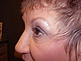 blepharoplasty post-op photos female senior
