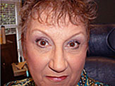 blepharoplasty post-op photos female senior 2