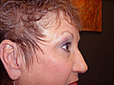 blepharoplasty post-op photos female senior 3