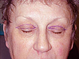 blepharoplasty pre-op photos female senior 3