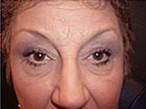 blepharoplasty pre-op photos female senior 2