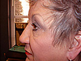 blepharoplasty pre-op photos female senior