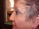 blepharoplasty pre-op photos female senior