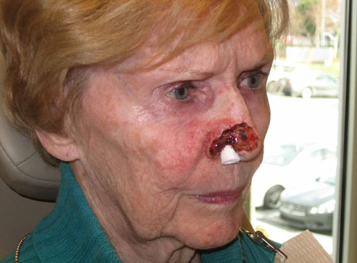 forehead flap pre-op senior white woman