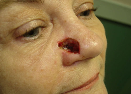 glabellar flap surgery pre-op white 60 year old woman