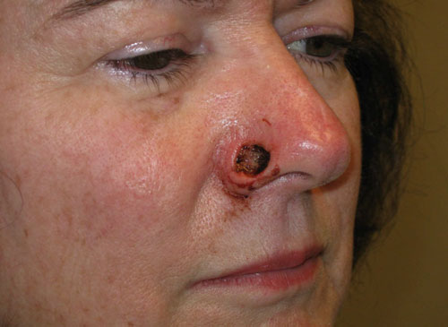 nasolablial flap surgery pre-op white 40 year old woman