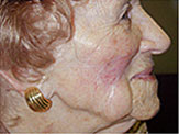 skin graft post-op senior white woman