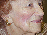 skin graft post-op senior white woman 2