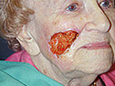 skin graft pre-op senior white woman