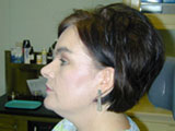 rhinoplasty post-op photos woman 40 year old white left side