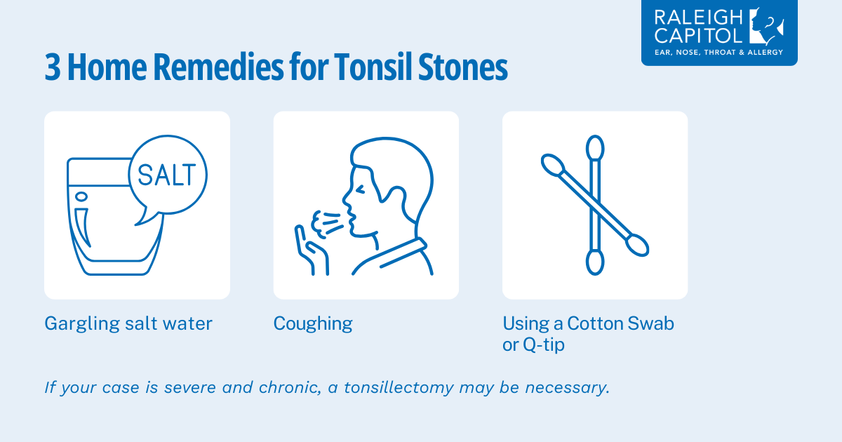 Tonsil stones home remedies